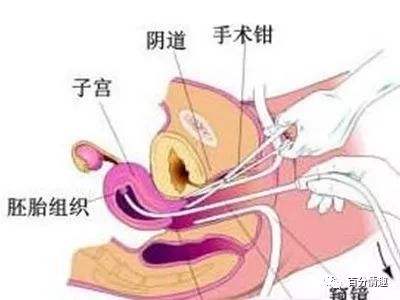 自然流产后多久来月经?